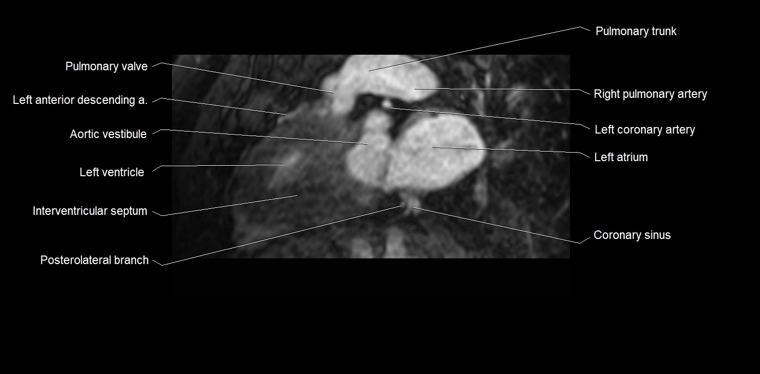 MRI heart and coronary arteries two chamber(sagittal)  anatomy image 22.webp